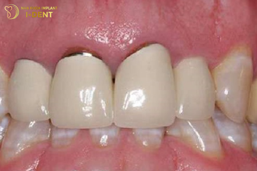 bọc răng sứ bị hôi miệng
