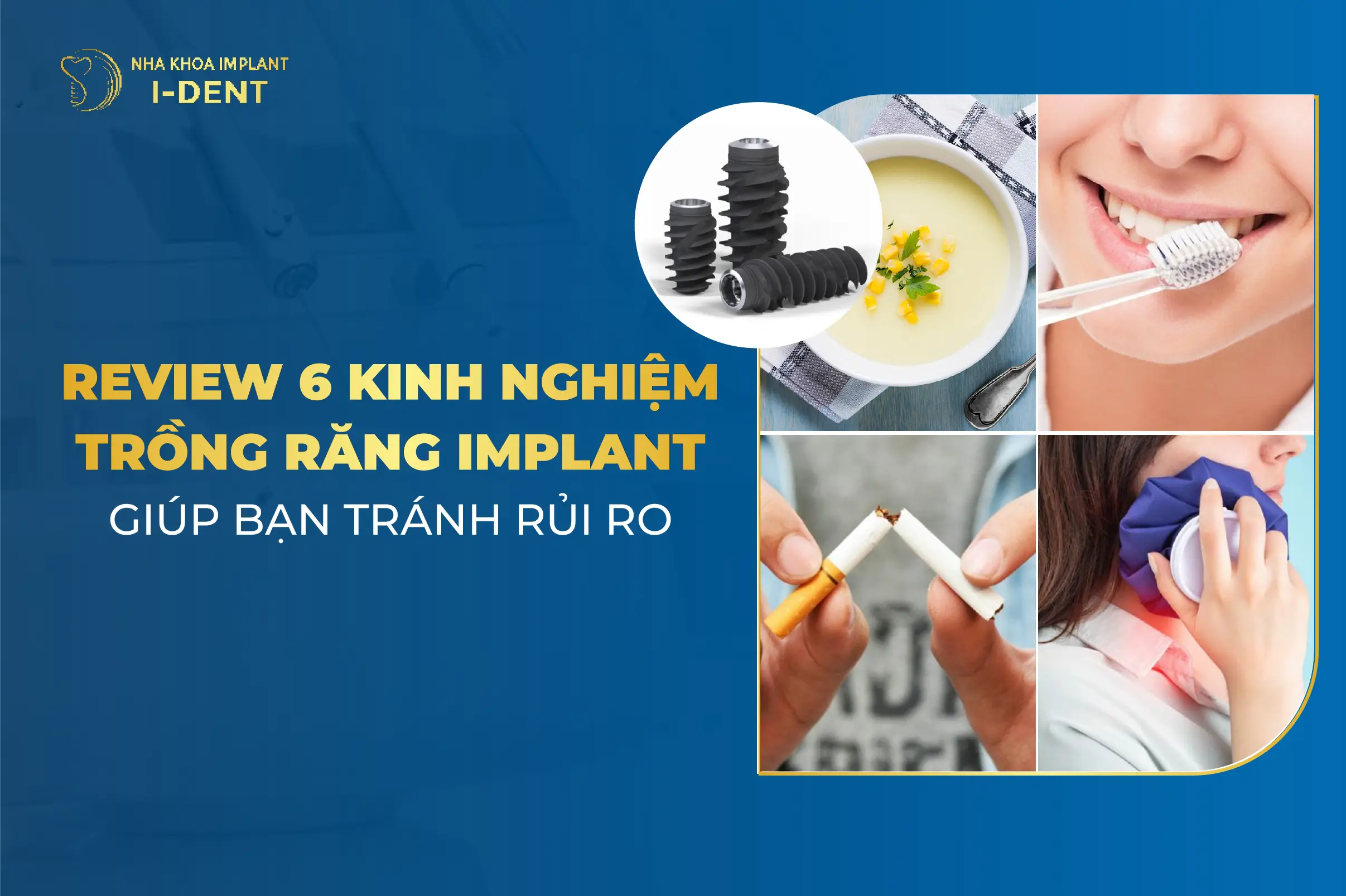 Review 6 Kinh Nghiem Trong Rang Implant