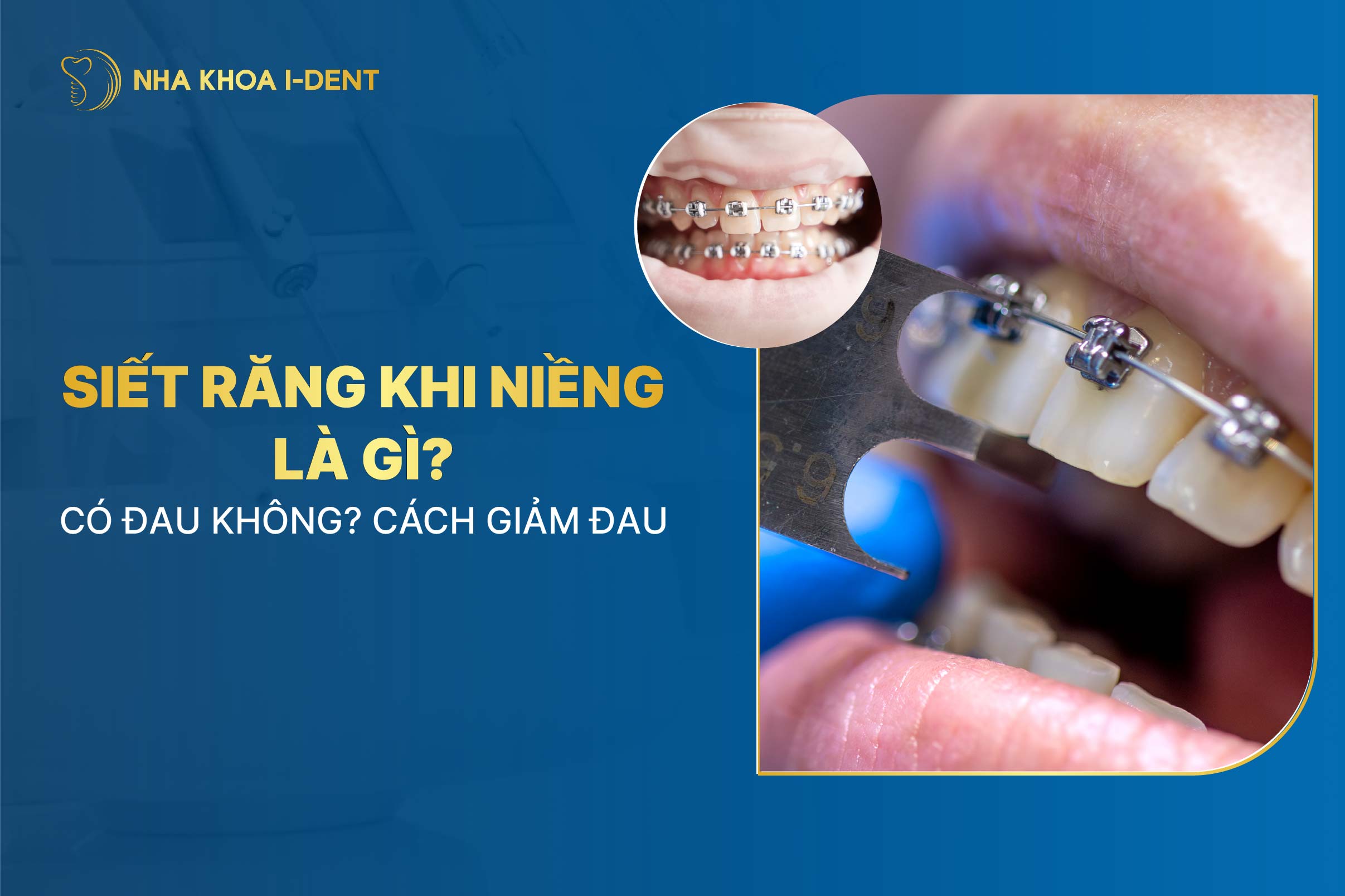 Siết Răng Khi Niềng