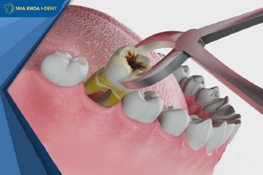tác hại của việc nhổ răng khôn