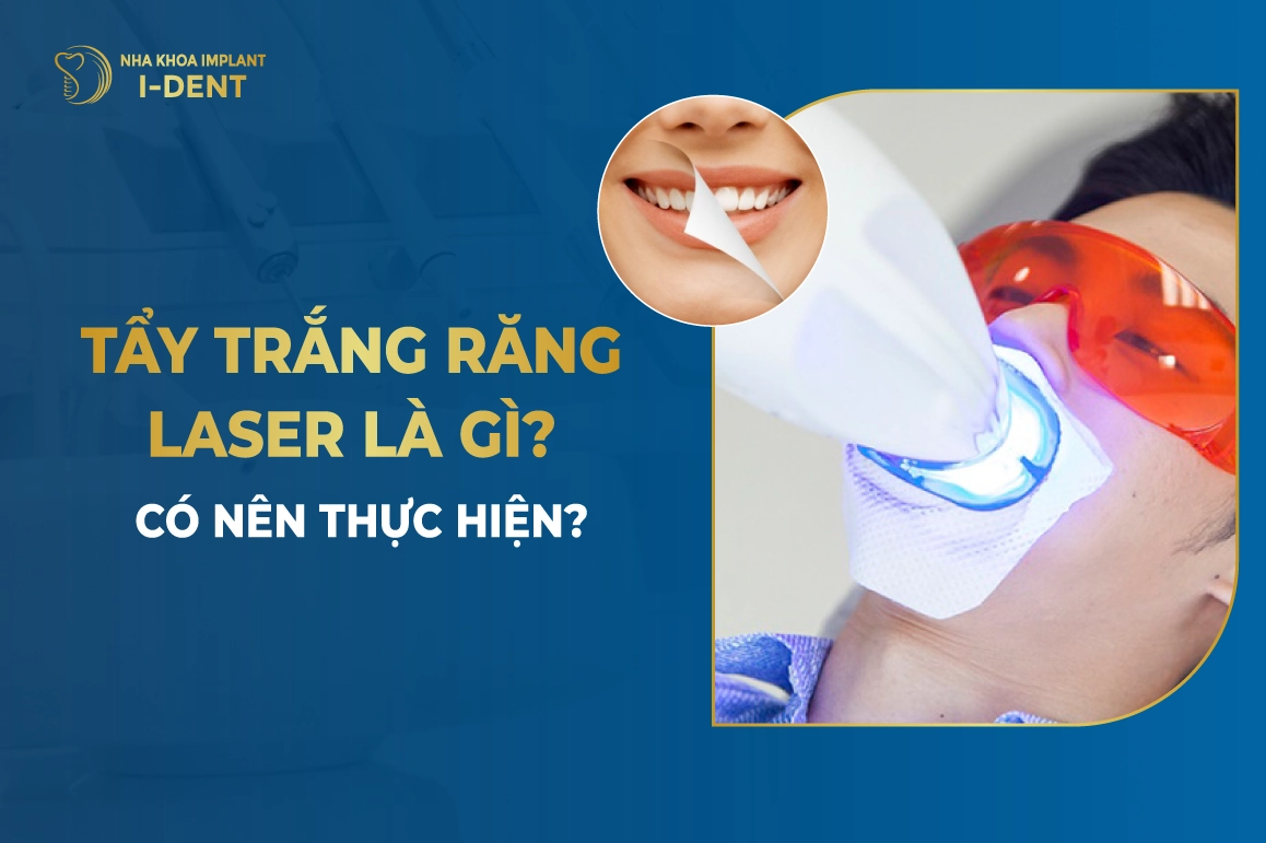 Tay Trang Rang Laser La Gi