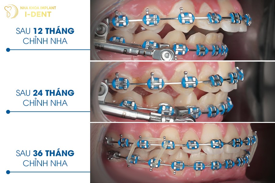 Thời gian niềng răng 19 tuổi từ 18 - 36 tháng