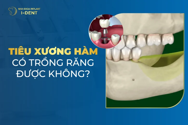 Tiêu Xương Hàm Có Trồng Răng Được Không?