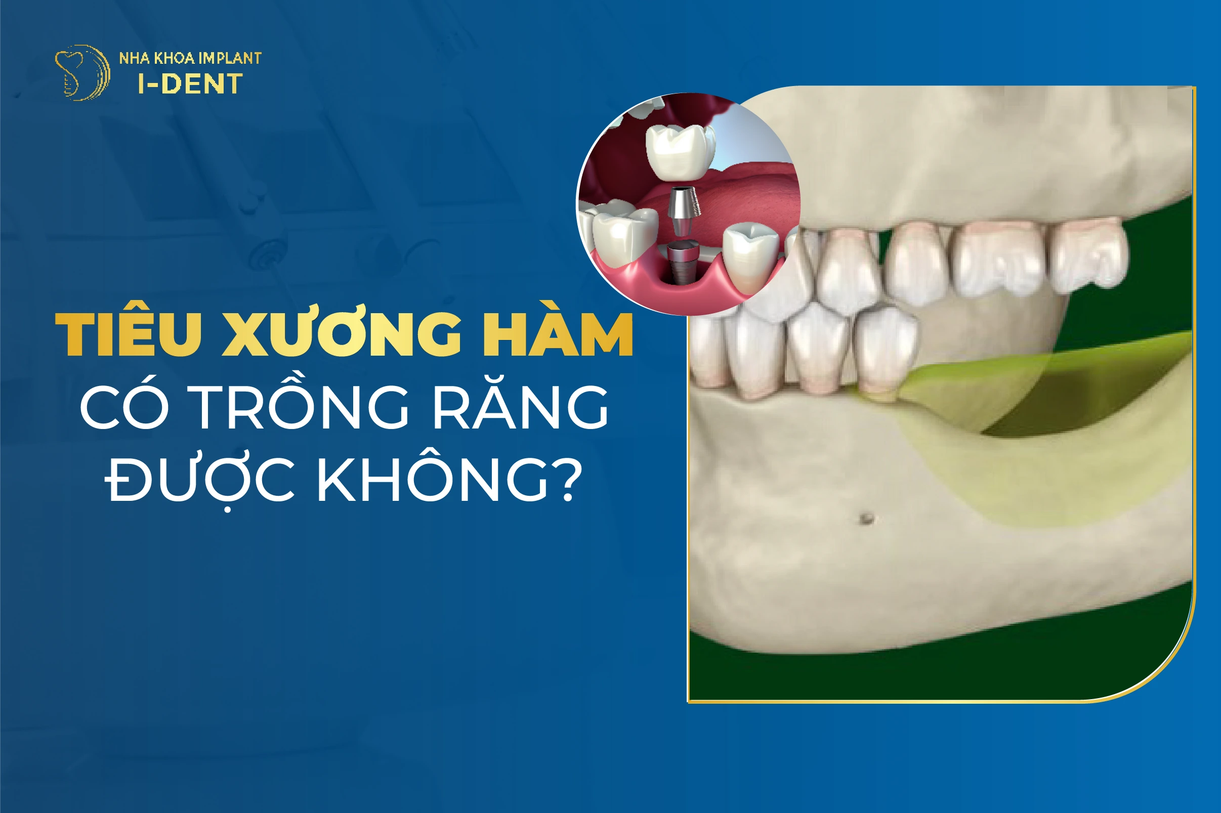 Tieu Xuong Ham Co Trong Rang Duoc Khong