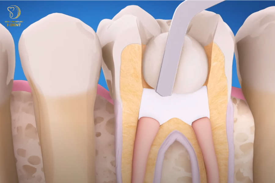 Trám răng là phương pháp chữa trị răng sâu phổ biến Trám răng là phương pháp chữa trị răng sâu phổ biến