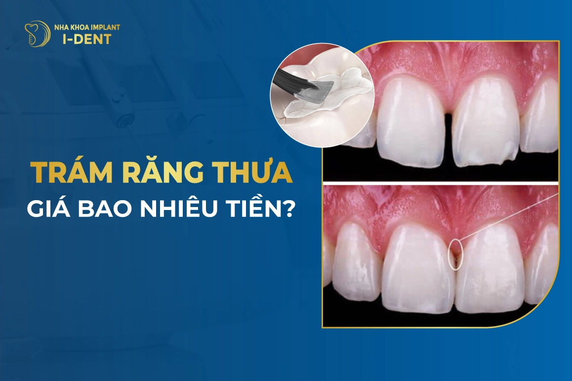 Tram Rang Thua Bao Nhieu Tien