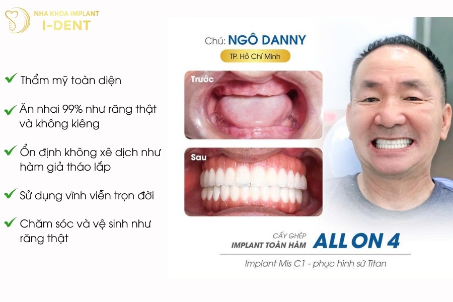implant là gì
