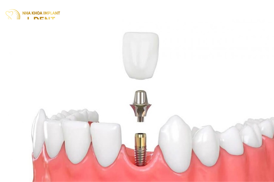 cầu răng sứ và implant