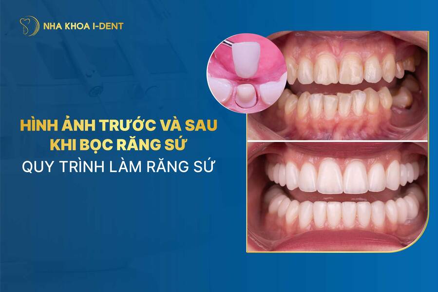 Truoc Va Sau Khi Lam Rang Su
