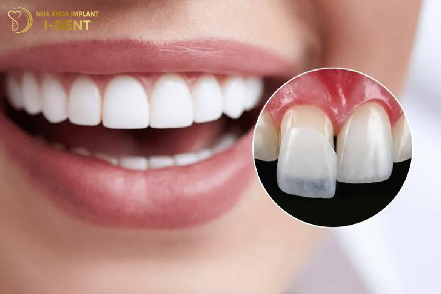Tuổi thọ trung bình của mặt sứ Veneer Lisi Press là từ 15 - 20 năm.