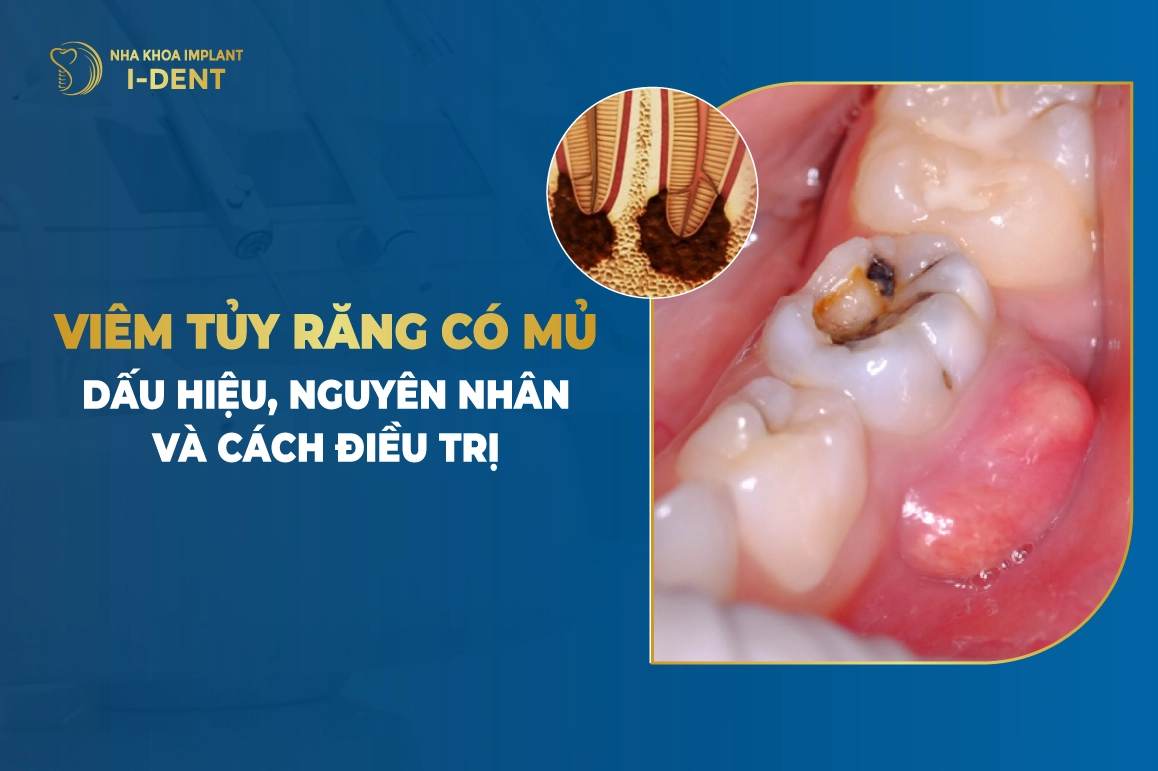 Viem Tuy Rang Co Mu