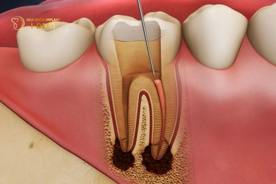 tác hại bọc răng sứ