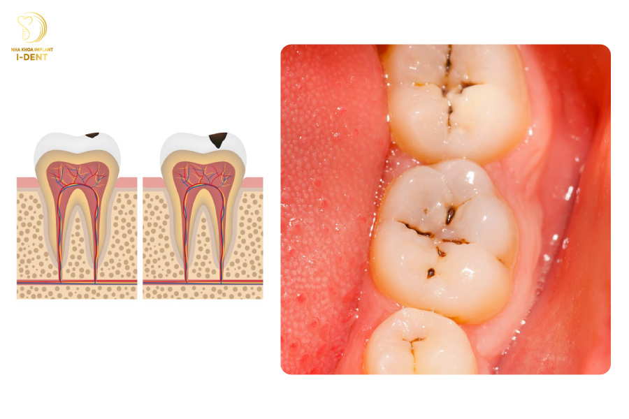 Dấu hiệu bị sâu răng xuất hiện các đốm đen trên bề mặt Dấu hiệu bị sâu răng xuất hiện các đốm đen trên bề mặt
