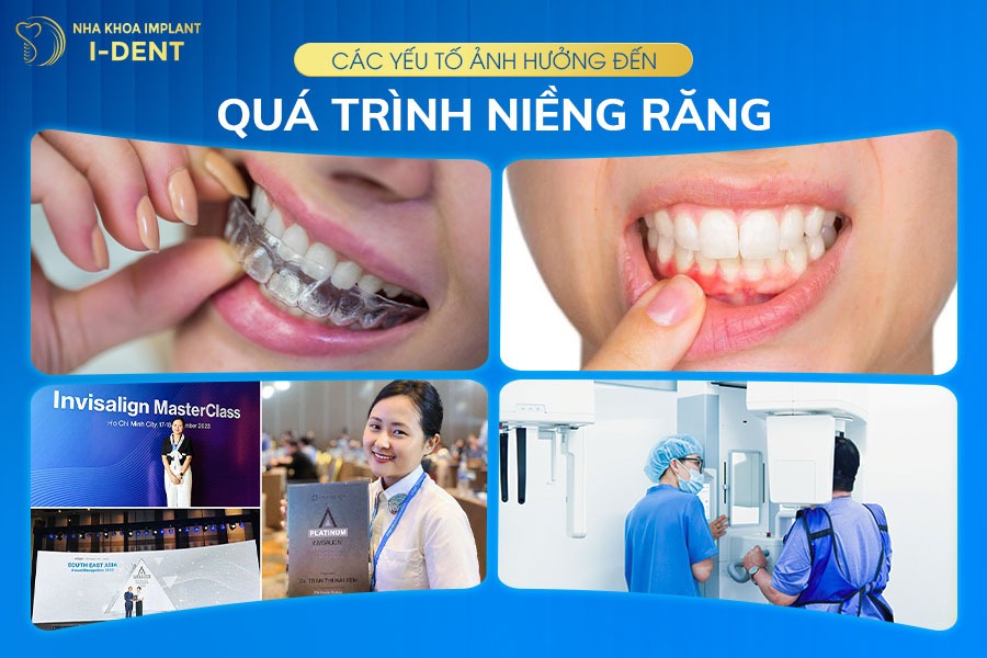 Yếu tố tác động đến giá niềng răng 19 tuổi